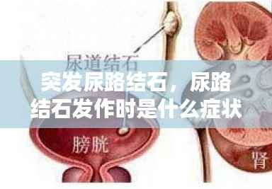 突发尿路结石,尿路结石发作时是什么症状?
